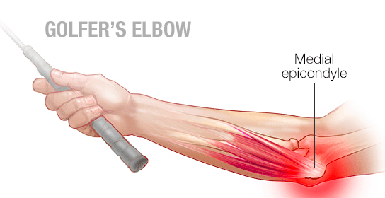 golfers-elbow