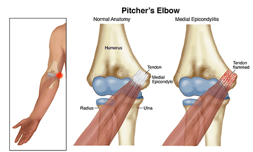 pitchers-elbow