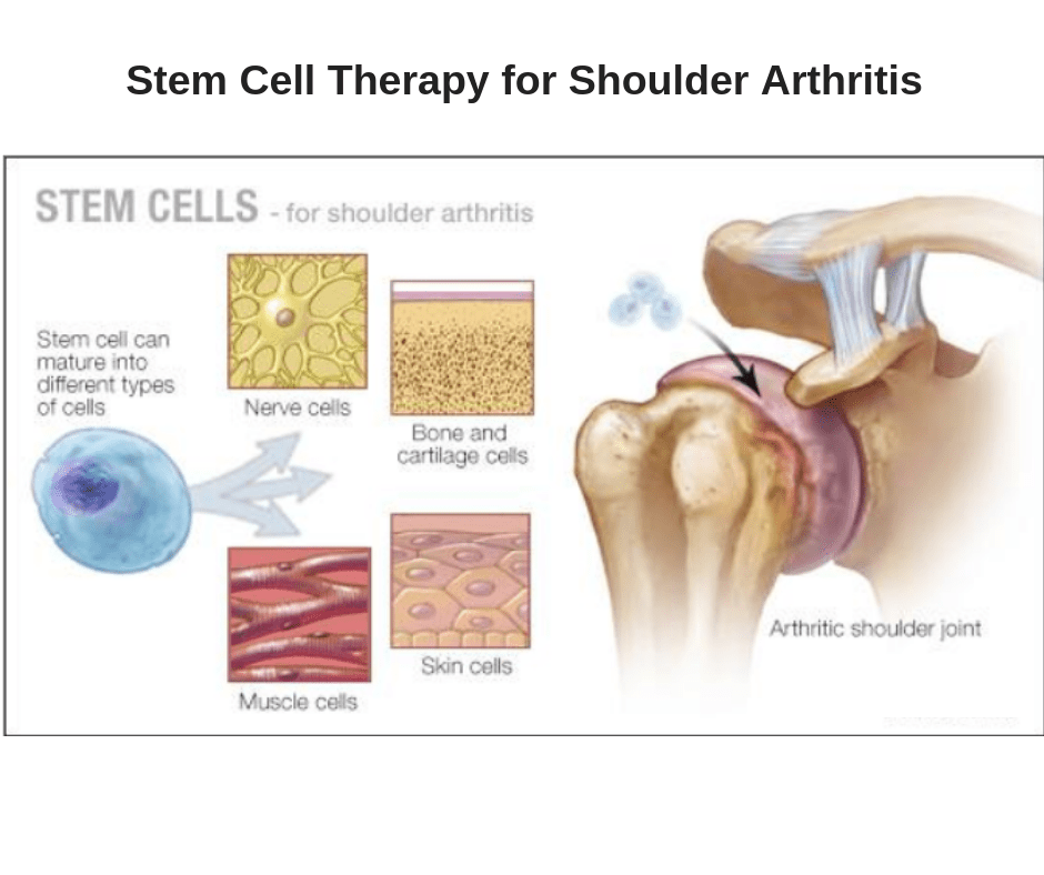 shoulder-pain