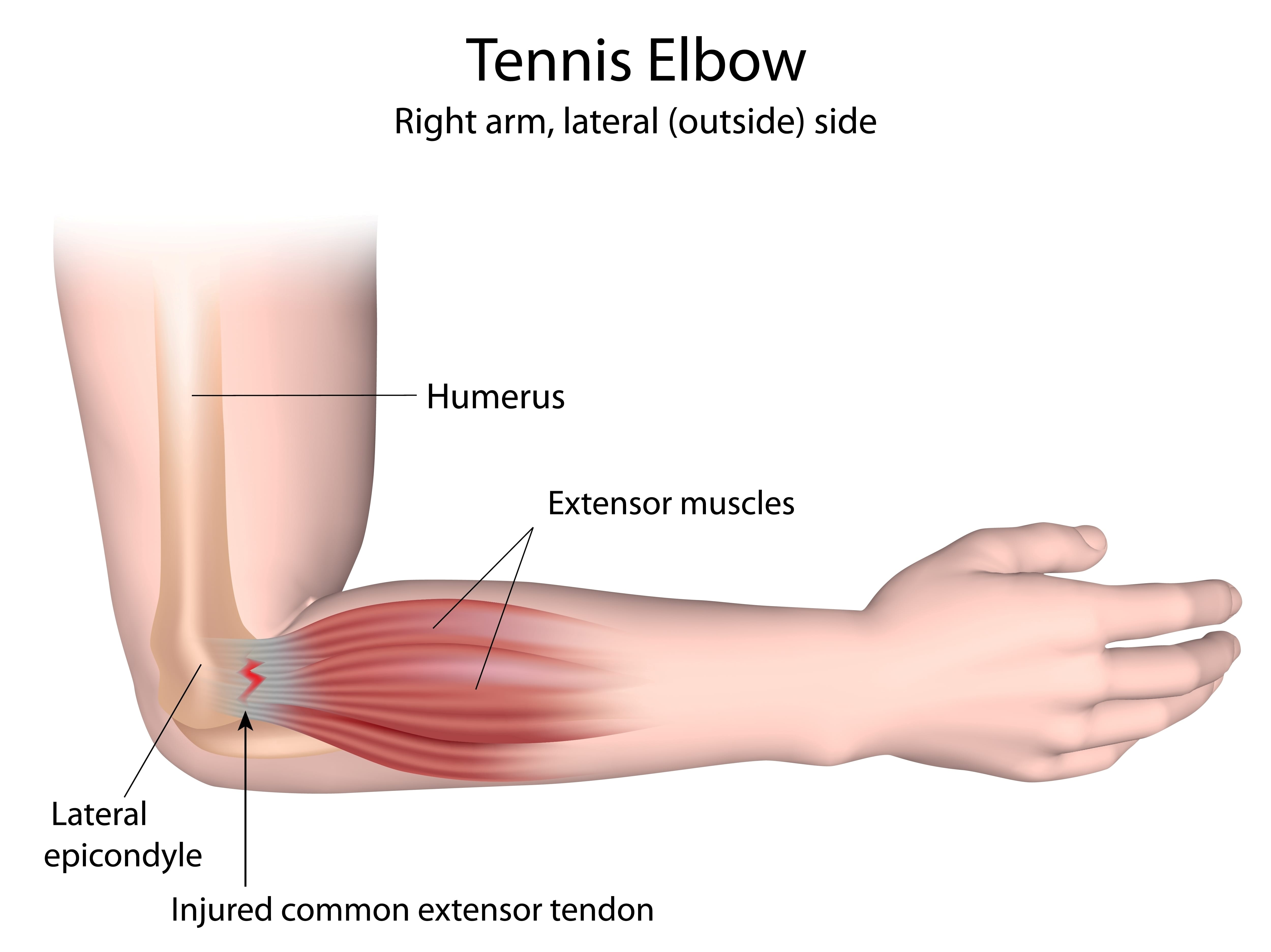 tennis-elbow